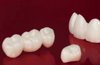 Răng sứ Ceramill