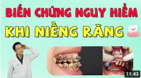 Các Biến Chứng Nguy Hiểm Thường Gặp Khi Niềng Răng